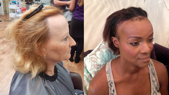 Two women with Frontal Fibrosing Alopecia showing receding hair line