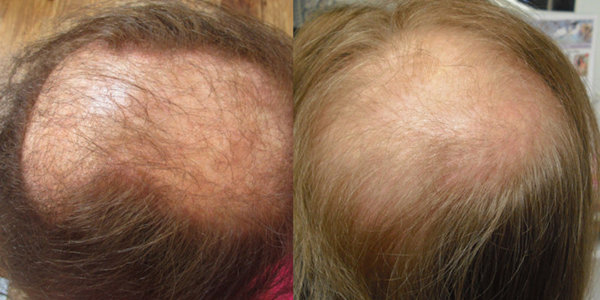 Top view of women suffereign female pattern hair loss