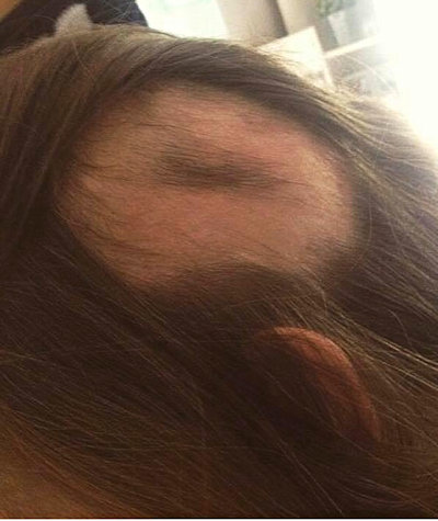 A growing bald patch due to Alopecia