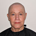 before Hair Replacement