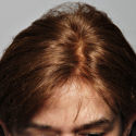 after Hair Replacement  treatment