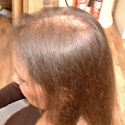 before Hair Replacement  treatment