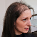 Robina before treatment