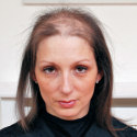 Robina before treatment