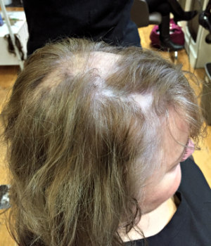 Caroline showing the effects of LPP