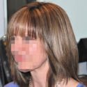 Alopecia case after treatment
