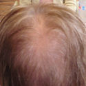 Alopecia case before treatment