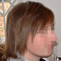 Alopecia case after treatment