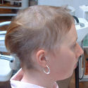 Alopecia case before treatment