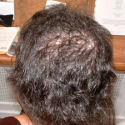 Trich case after treatment