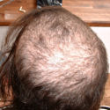 Trich case before treatment
