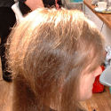 Trichotillomania case after treatment