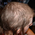Trichotillomania case before treatment