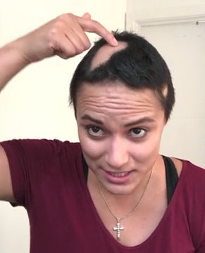 Laura showing her alopecia