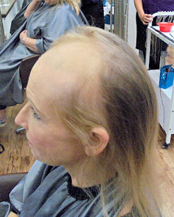 Erica before Intralace