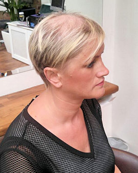 The Intralace System for disguising hair loss - Lucinda Ellery UK