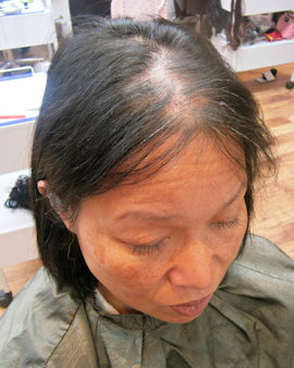 before Intralace Minima treatment