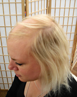 Intralace Gallery - before and after Intralace System hair loss treatment