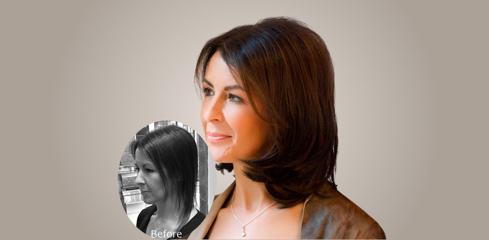 Hair Loss Treatment For Women - Lucinda Ellery UK