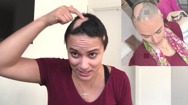 Laura discusses her hair loss from alopecia